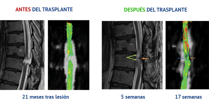 Antes y después del trasplante